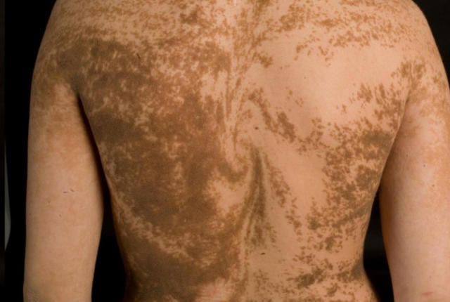 کایمریسم انسانی